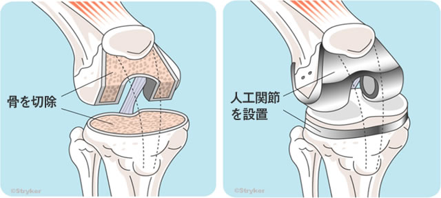 膝の手術の前に読んで