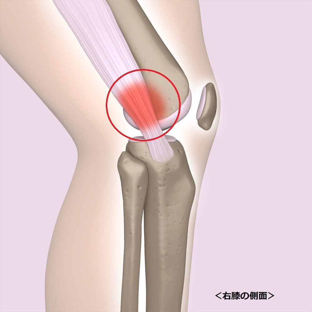 マラソンで膝が痛くなる原因と対処